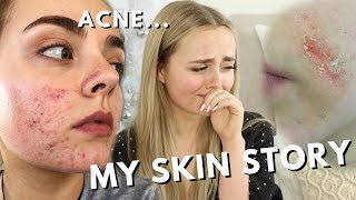 MY SKIN STORY | MY LONG BATTLE WITH ACNE | Conagh Kathleen