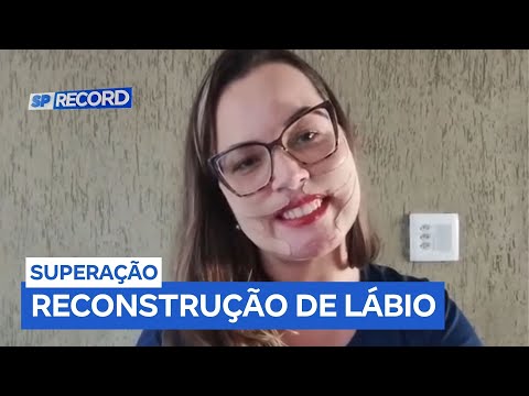 Modelo de Matão reconstrói lábio após reação grave a procedimento estético