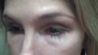 Plastic surgeon:Dr. Jeffrey S. Epstein - Female, Angelique,Dark Under Eye Circles