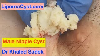 Dr Khaled Sadek. Nipple Cyst Released. LipomaCyst.com