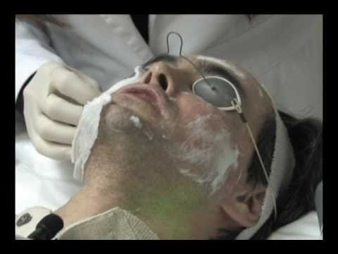 Laser skin resurfacing for Acne scars part 2
