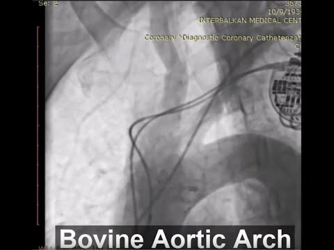 A step by step TAVI using Portico FlexNav system