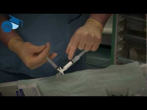 Making foam sclerotherapy using the Tessari method (varicose veins)