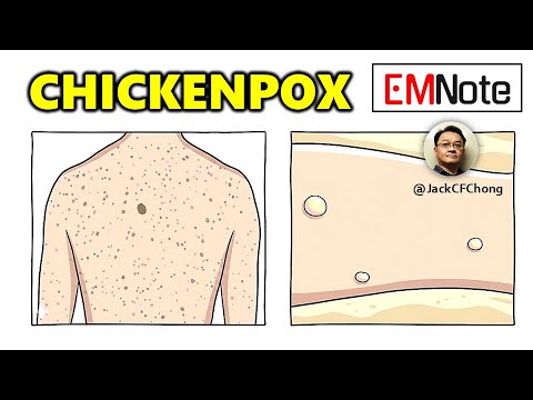 Chickenpox or Varicella