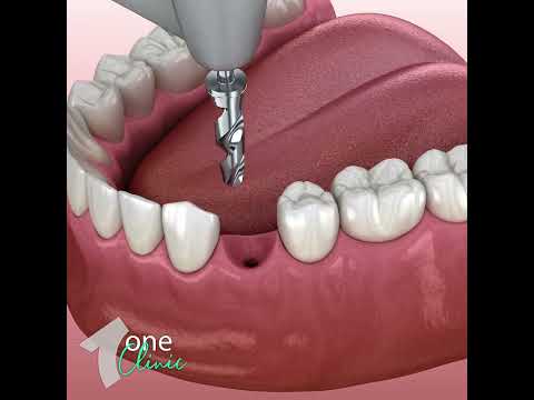 Immediate Load Dental Implants (Straumann) - Surgical Procedure - One Clinic Patient Review Video