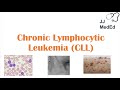 Chronic Lymphocytic Leukemia CLL Symptoms Ex Skin Blisters Diagnosis And Treatment Vit D