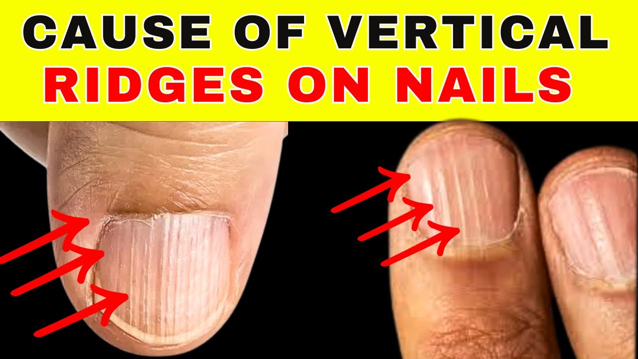 Do You Have Vertical Nail Ridges? Here’s What They Mean!