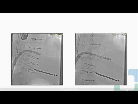 Ss9 TEER for Mitral Regurgitation Secondary to Mitral Ring Dehiscence Freemedbooks.com