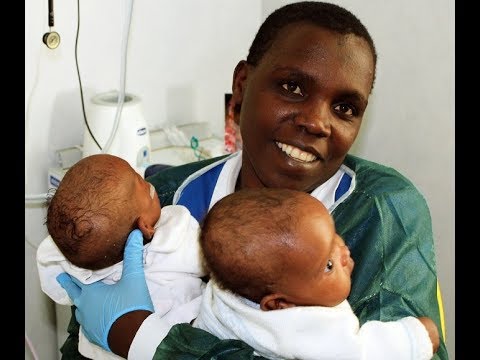 Separate due gemelline siamesi del Burundi