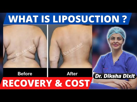 Best Liposuction / Fat Removal Surgery in Delhi