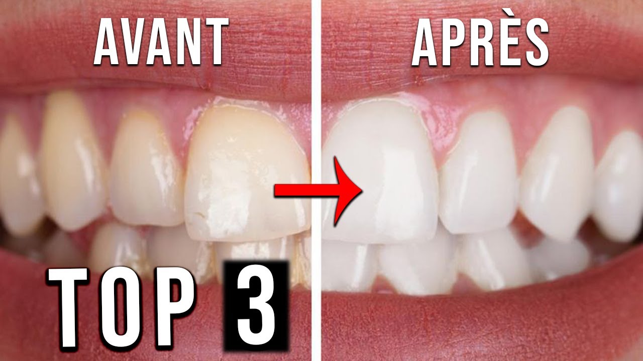 TOP3 : Meilleur Kit de Blanchiment Dentaire de 2022