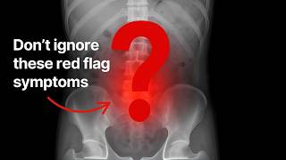 7 Warning Signs of Diverticulitis Most Doctors Miss