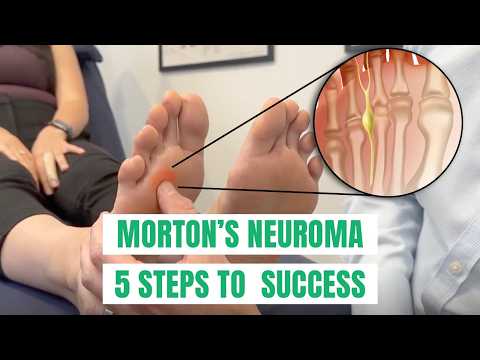 Morton’s Neuroma: 5 tips to Solve Forefoot Pain