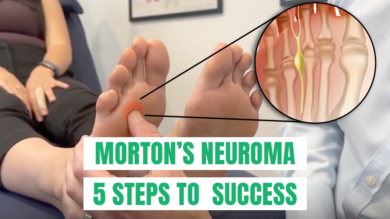 Morton’s Neuroma: 5 tips to Solve Forefoot Pain