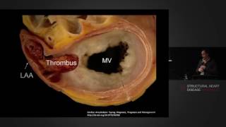 Removal of the Left Atrial Appendage During Cardiac Surgery – Prof Michael Vallely