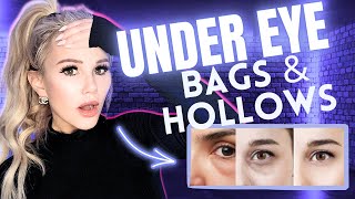 How to REMOVE Under-Eye Bags & Hollows (best treatments)