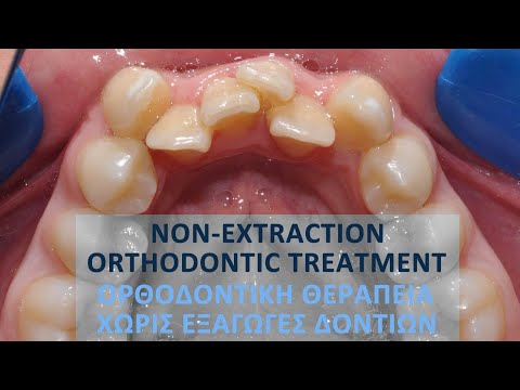 Non-extraction Orthodontic Treatment 