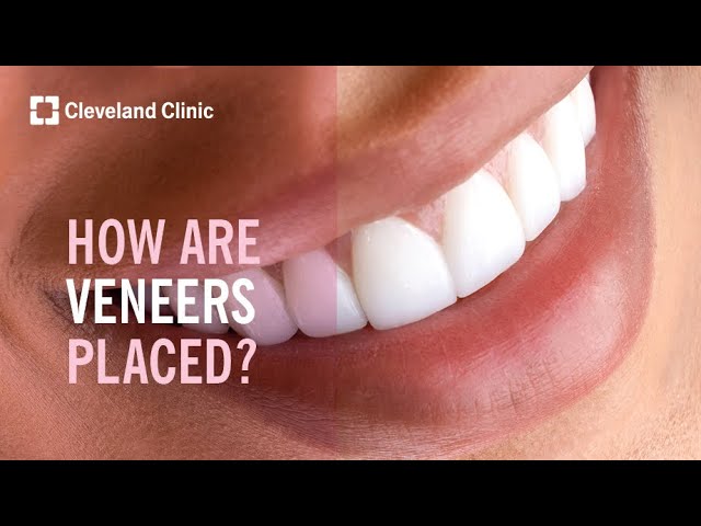 How Are Veneers Placed?
