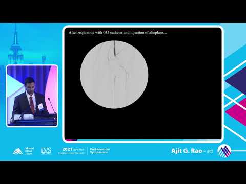 Complications and Bailouts Embolizaiton Case 1 - Ajit G  Rao, MD