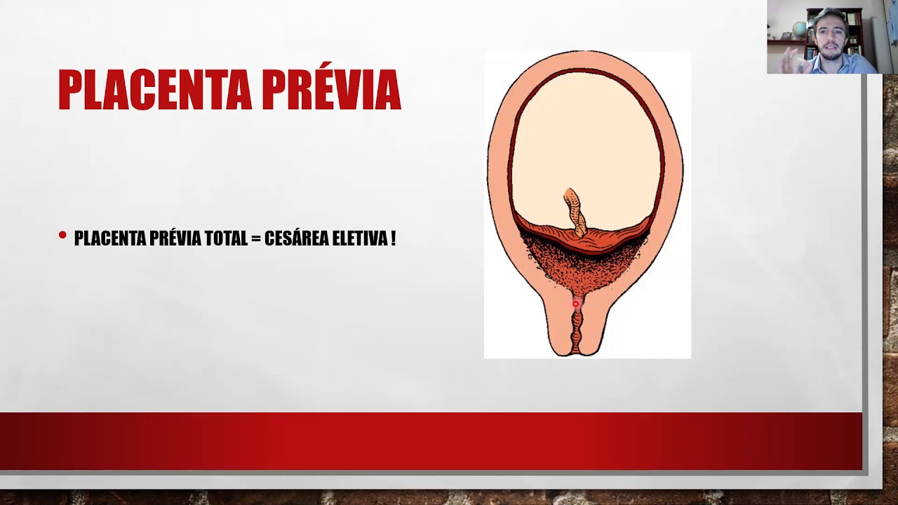 Aula 6 - Hemorragias da segunda metade