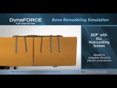 How Do DynaForce™ Staple Compression Plates™(SCP) Work?  - Gap Recovery, Apposition, Speed