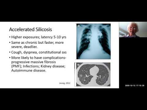 Silicosis – old disease, new exposures, regulation for prevention!