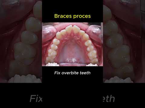 How to fix overbite teeth? Braces process transform #dentist #braces #orthodontist