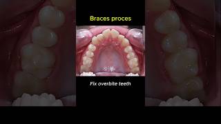 Download lagu How to fix overbite teeth? Braces process transform #dentist #braces #orthodontist mp3