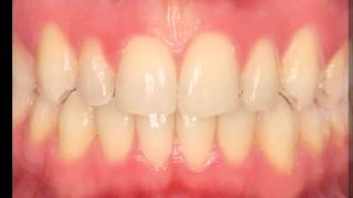 Blanqueamiento en clínica - Clínica Dental García Rielo