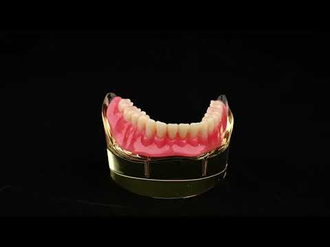 iDENTical Mandibular Overdenture Model with 2 Implants M6002