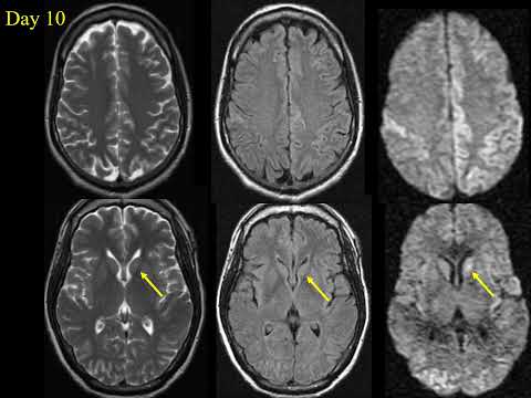 Prion Diseases   Kucharczyk   Neuroradiology Nov 2021