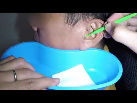 Man's Dry Flaky Earwax Removed - Did He Feel any Pain?
