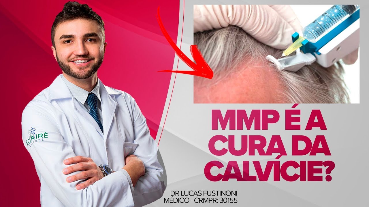 MMP É A CURA DA CALVÍCIE | Dr Lucas Fustinoni - Médico - CRMPR 30155