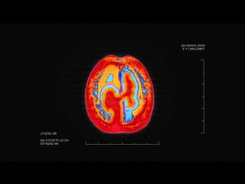 Brain Scan PSA for Alzheimer Society of B.C.