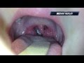 sore throat vs peritonsillar abscess 