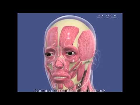 What is Botulinum Toxin? | Radium Medical Aesthetics