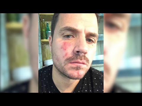 Dani Martín comparte un problema de piel con sus seguidores