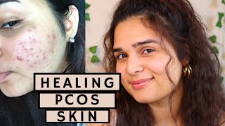 Healing My Skin From PCOS Acne and Marks At Home - 2022