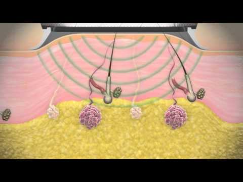 miraDry Technology Overview