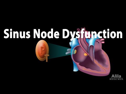 Learn Sinus Node Dysfunction Animation - Mind Luster
