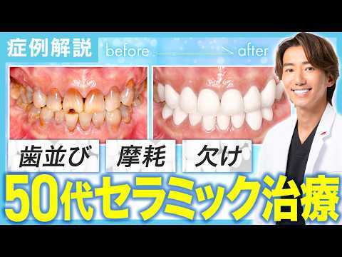 【ガタガタの歯を治したい】ひび割れ黄ばみ状態の歯をセラミック治療で白く美しい歯並びに改善【50代女性/16本セラミック症例】#セラミック治療