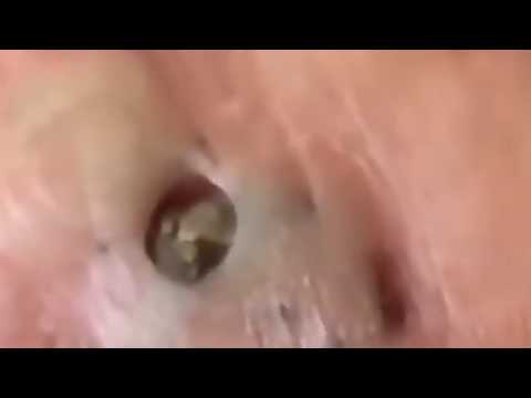 Выдавливание чёрных точек
