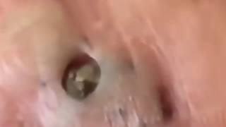 Выдавливание черных угрей новое