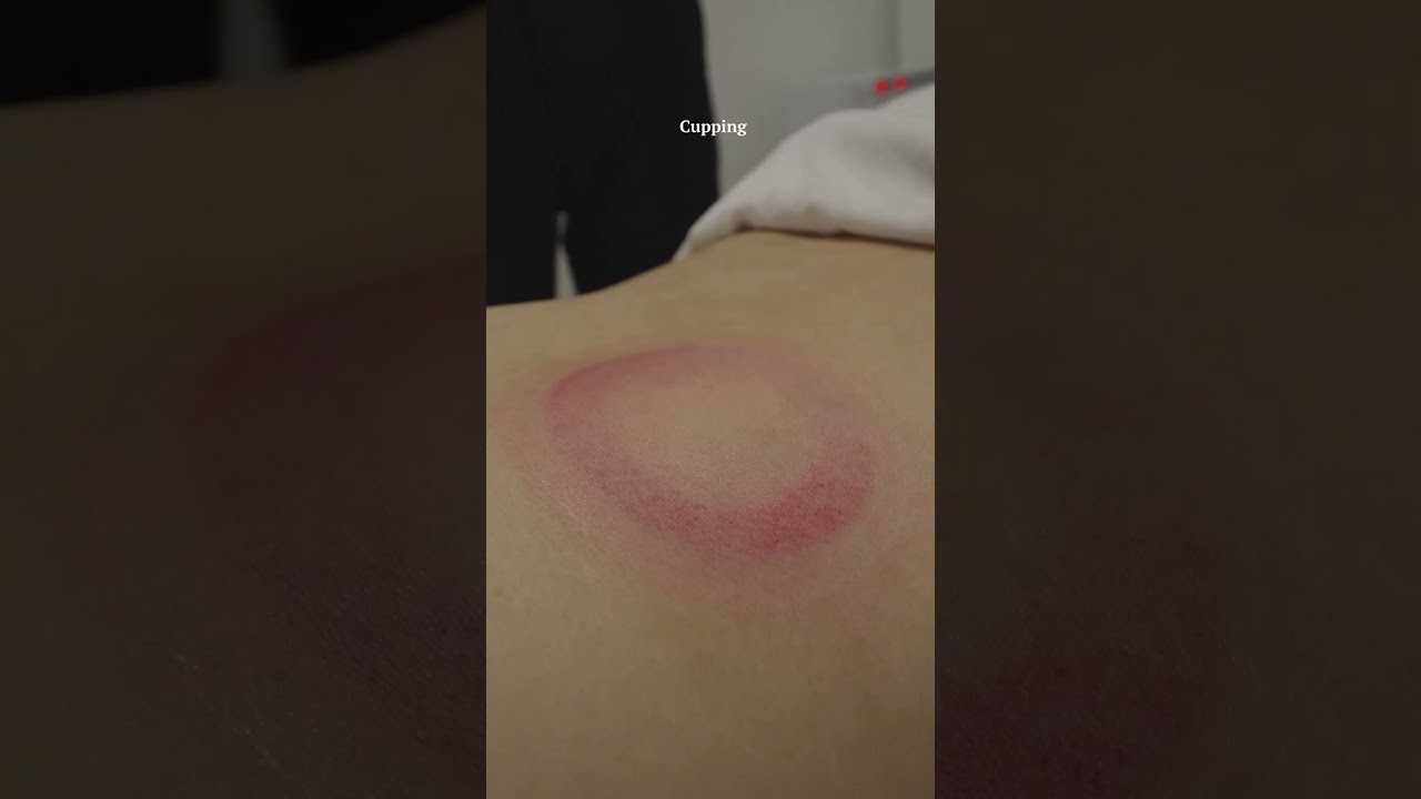 This Cupping Session Went Viral for a Reason 🔥#cupping #cuppingtherapy #wellness #massage