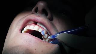 ¿Qué son las Carillas Dentales - Colocación de Carillas Dentales paso a paso