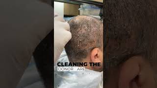 Head Wash After Hair Transplant | 1st Head Wash | Scabs Removal