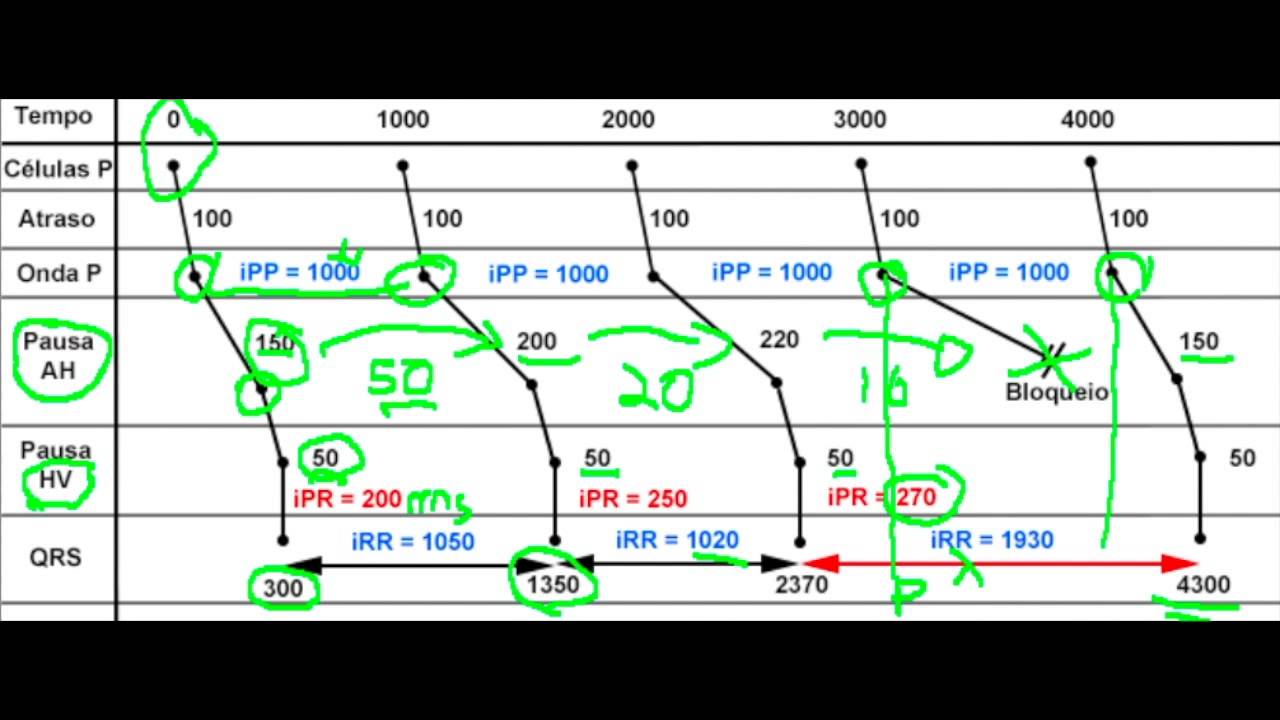Descomplicando o ECG Aula 12 Parte 2 - Bloqueio atrioventricular de segundo grau (BAV 2G)