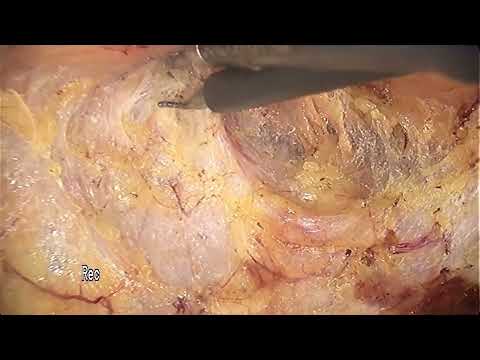Laparoscopic abdominoperineal resection