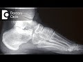 Can Cuboid Fracture heal post 4 months of injury if it was undiagnosed till then?- Dr. Mohan M R