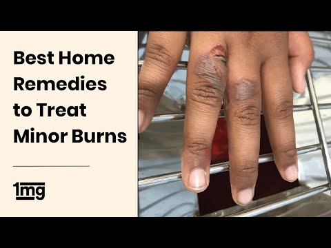 Best Home Remedies to Treat Minor Burns | 1mg